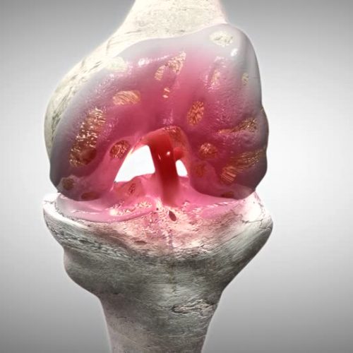 Diz Kireçlenmesinde Ameliyat Dışı Tedavi