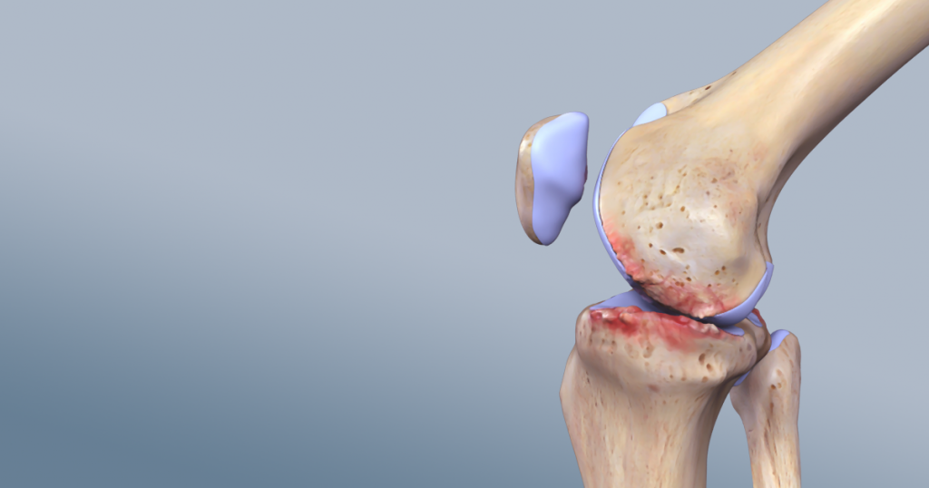 Kıkırdak hasarı her eklemde olabilir ancak en sık dizde kıkırdak hasarı görülür.